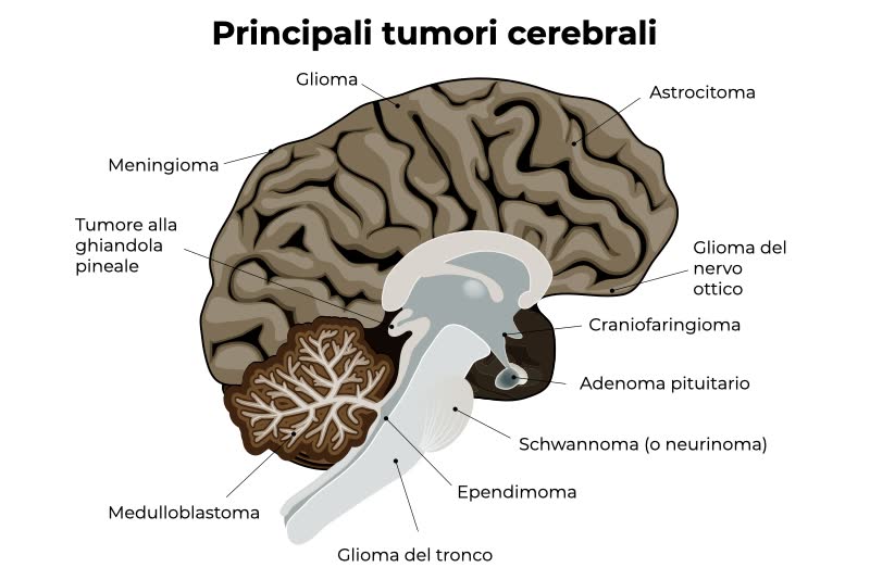 Illustrazione di un cervello con la nomenclatura di alcuni dei principali tumori cerebrali, tra cui il glioma