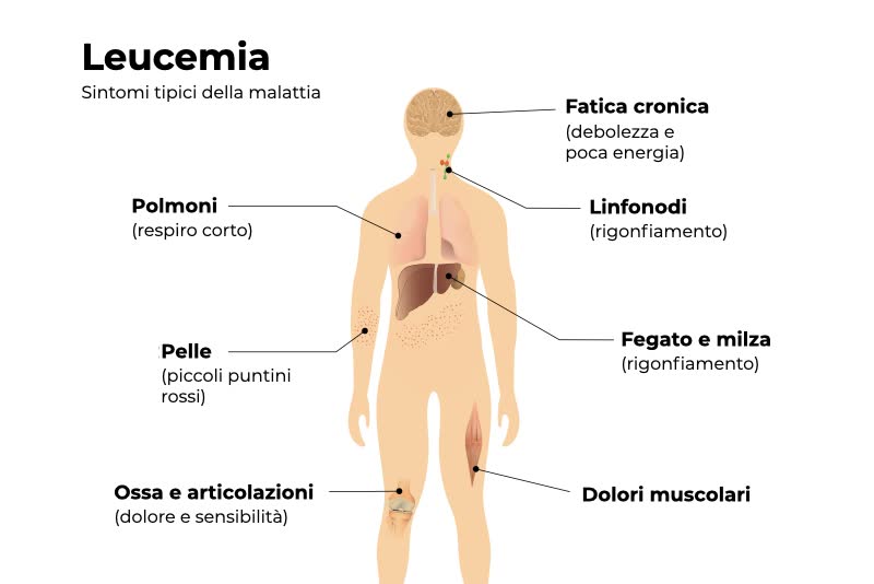 Illustrazione di una figura umana affetta da leucemia con riferimento ai principali sintomi percepiti a livello cronico, linfonodale, epatico, muscolare, dermatologico, polmonare, osseo e articolare