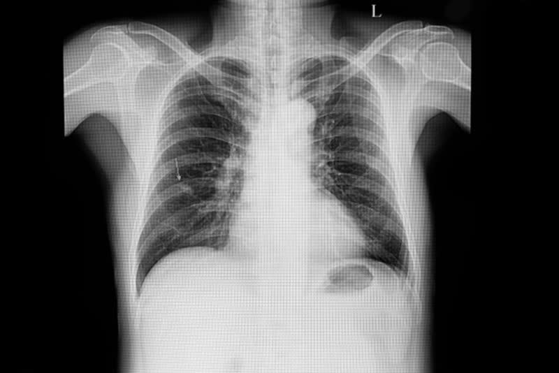 Immagine a raggi X dei polmoni di un paziente con amartoma, il più comune tumore benigno dei polmoni