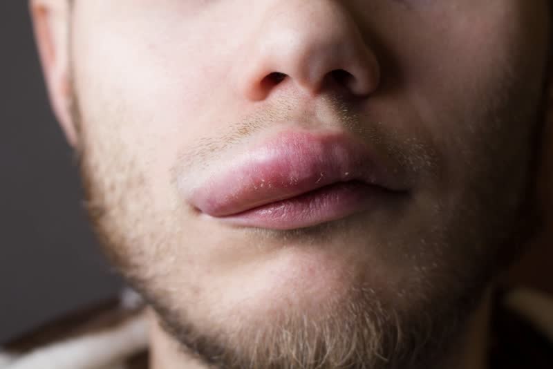 Primo piano di uomo con labbra gonfie, chiaro sintomo di angioedema ereditario