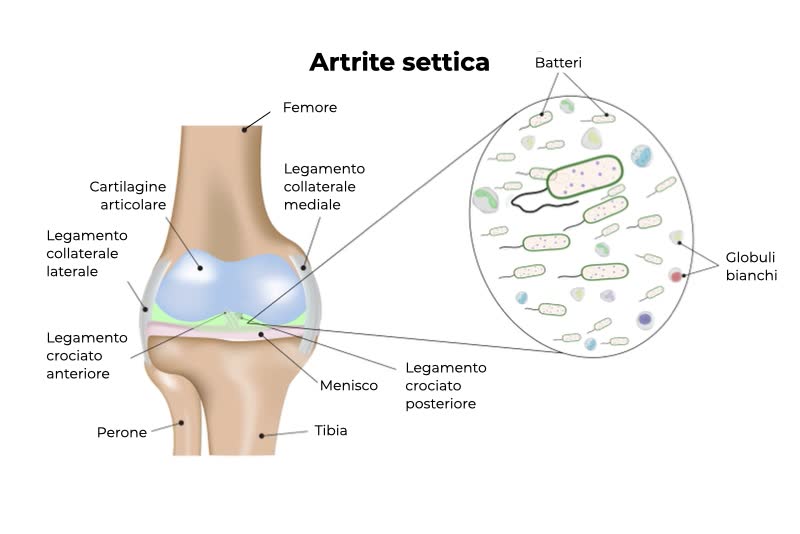 Illustrazione di ginocchio affetto da artrite settica con ingrandimento sulla zona colpita che presenta batteri e globuli bianchi
