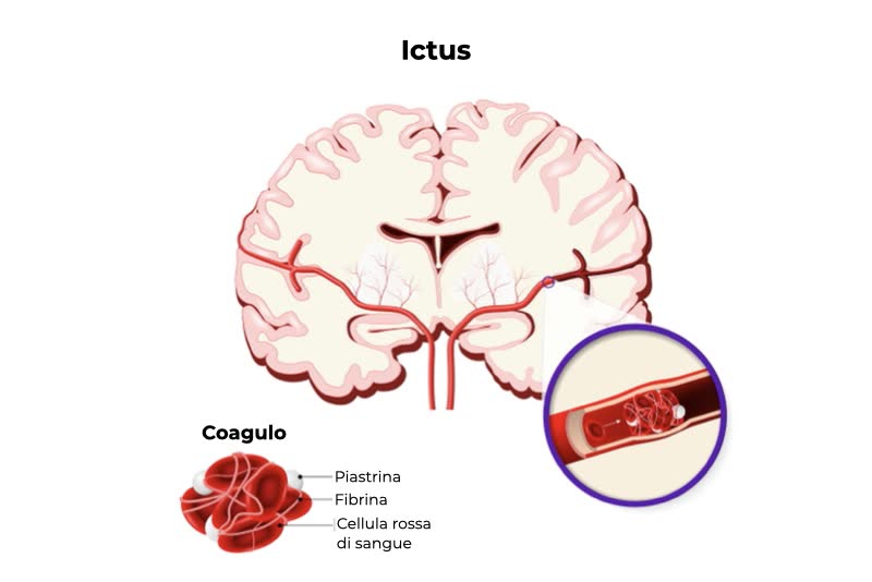 Illustrazione di cervello con ingrandimento su vena cerebrale con ictus, con ingrandimento sul coagulo