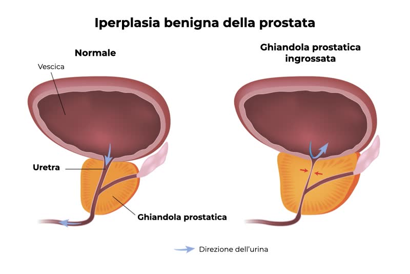 Illustrazione di una vescica e prostata normali e ingrandite a causa di iperplasia prostatica benigna