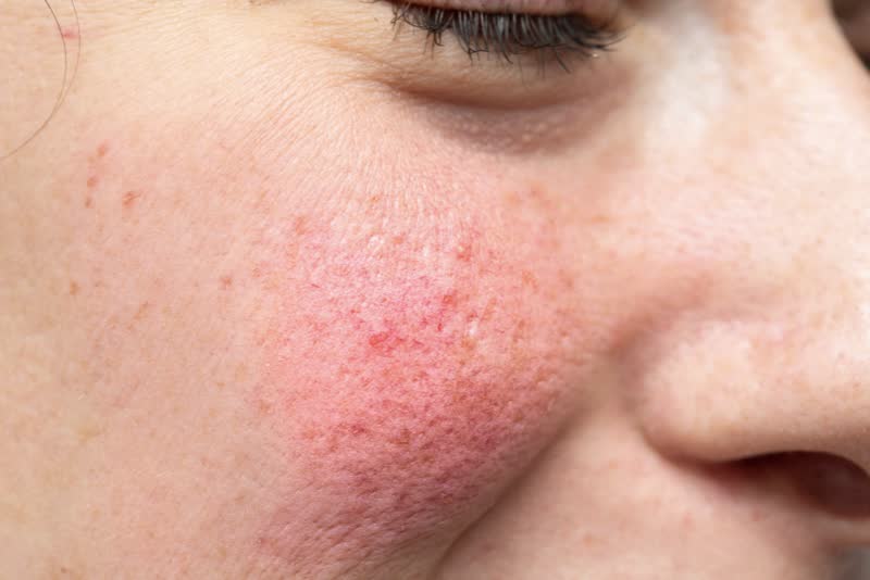 Foto di una giovane donne con un eritema severo della pelle sulla guancia destra della faccia