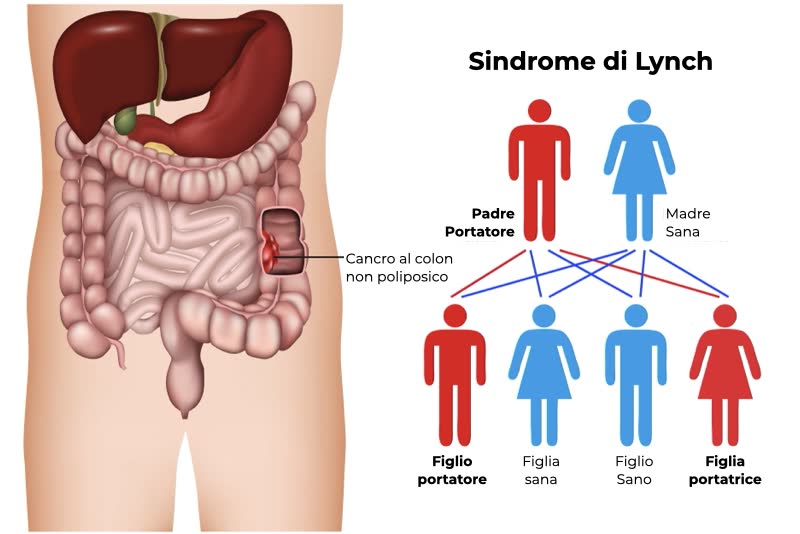 Illustrazione della sindrome di Lynch con ingrandimento su tumore al colon non poliposico con a destra una rappresentazione dell'evoluzione genetica tra discendenti e genitori sani e portatori
