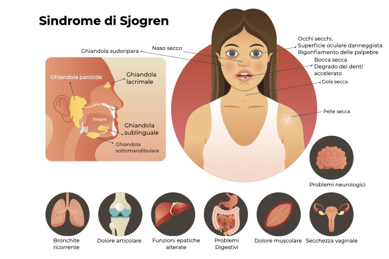 Illustrazione di una ragazza con sintomi della sindrome di sjogren con ingrandimento a sinistra della porzione facciale e icone 