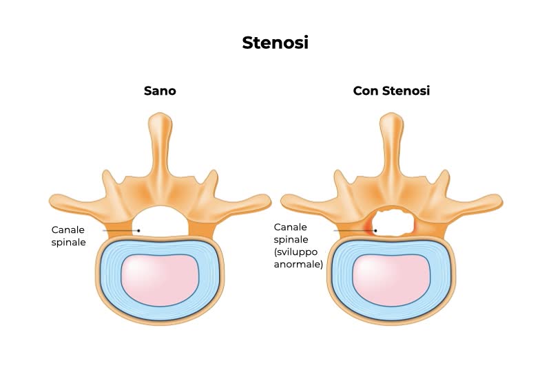 Illustrazione di una stenosi con figura a sinistra di una colonna vertebrale sana a sinistra e una con stenosi a sinistra, con canale spinale con una grandezza insolita (piccola)