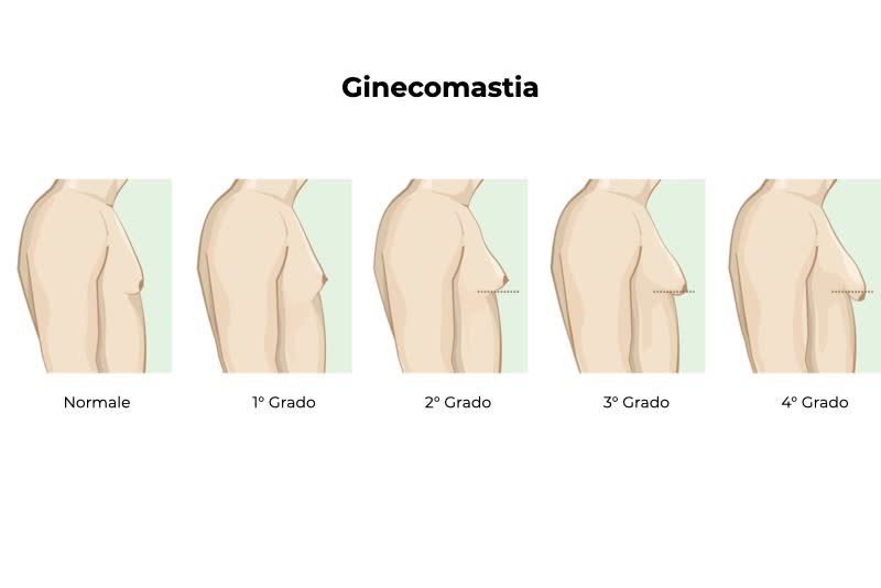 Illustrazione che classifica i vari gradi di ginecomastia, lo sviluppo anomalo della mammella maschile, che può svariare dal grado normale fino al 4° grado