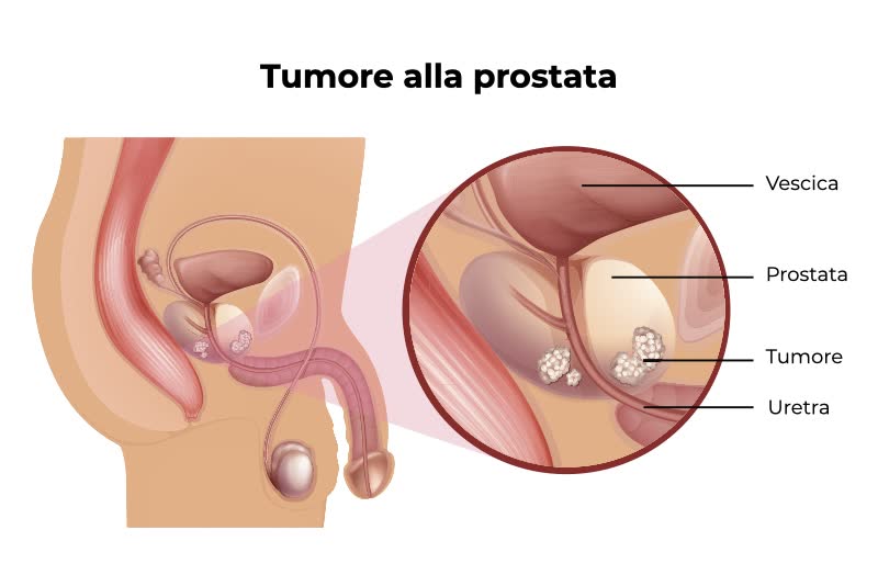Illustrazione dell'apparato riproduttore maschile con pene, testicoli, vescica e prostata e un ingrandimento sulla zona prostatica per mostrare una prostata affetta da tumore (carcinoma o neoplasia) alla prostata