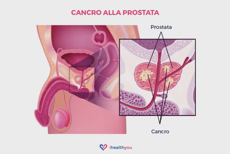 Illustrazione dell'apparato genitale maschile con focus su pene e testicoli per parlare di tumore alla prostata e tumore ai testicoli
