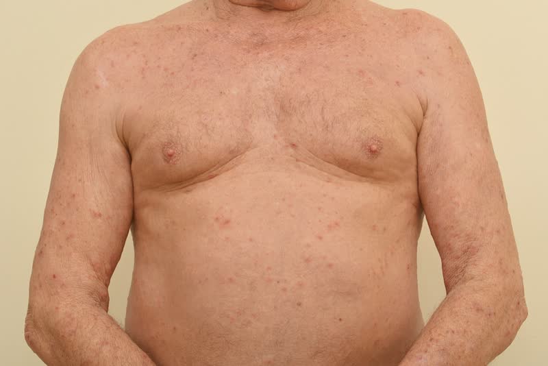 Foto del petto nudo di un uomo anziano ricoperto dai tipici puntini rossi dei soggetti che soffrono di scabbia