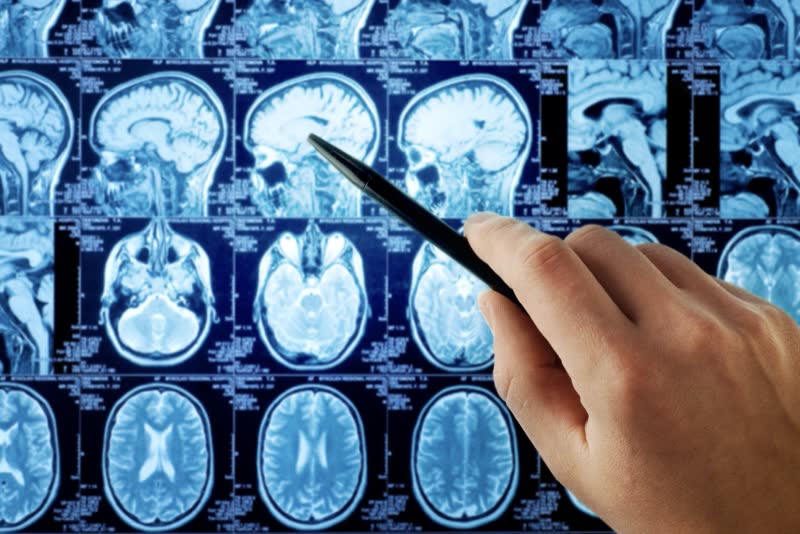 Foto di una lavagna luminosa sulla quale sono appoggiati test di imaging (tramite risonanza magnetica) di un cervello umano affetto da tumore al cervello. In primo piano una persona con in mano una penna indica un punto all'interno del cervello del paziente osservato