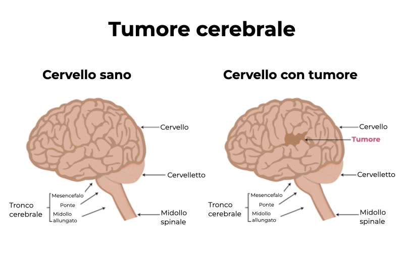 Illustrazione di due cervelli, uno sano e uno malato di tumore al cervello con relative spiegazioni anatomiche e rappresentazione grafica di come si presenta un tumore al cervello