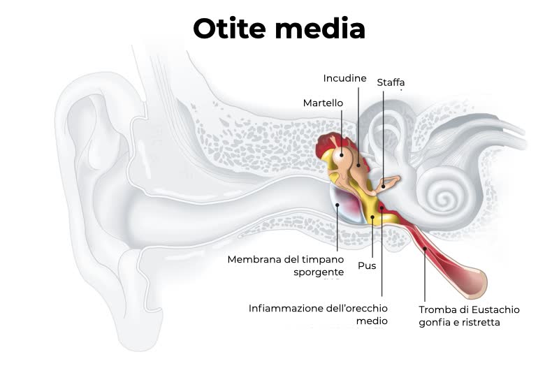 Rappresentazione grafica di un orecchio affetto da otite media con pus e componenti colpite da otite