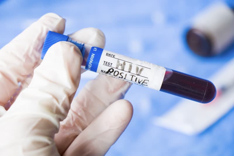 Foto di tecnico di laboratorio di analisi che tiene in mano una provetta di un test per hiv positivo testato su un paziente sofferente di immunodeficienza/immunodeficiente