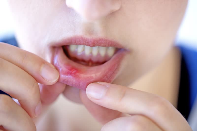 Foto di donna che si abbassa il labbro inferiore della bocca con le dita delle mani mostrando la tipica 