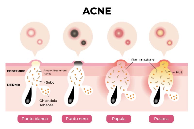 Illustrazione dei diversi tipologie di acne: dal punto bianco al punto nero, passando per pustola e papula, con relative descrizioni di cosa avviene a livello di derma ed epidermide