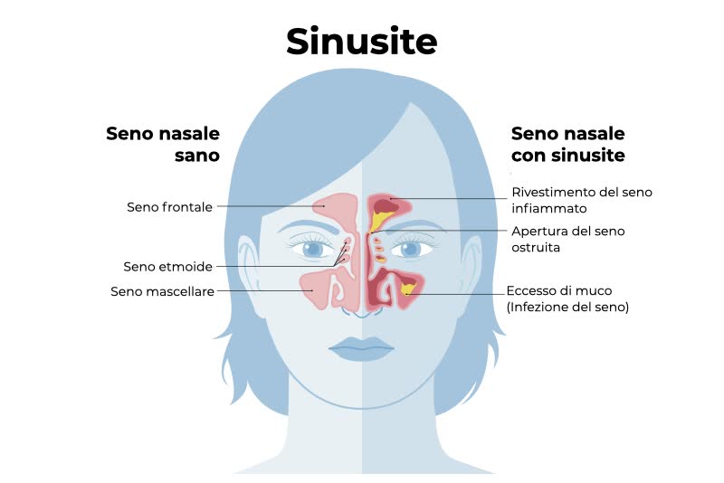 Illustrazione di un volto di una donna con seni nasali sani o con sinusite, rappresentata da eccessi di muco, infiammazioni e ostruzioni