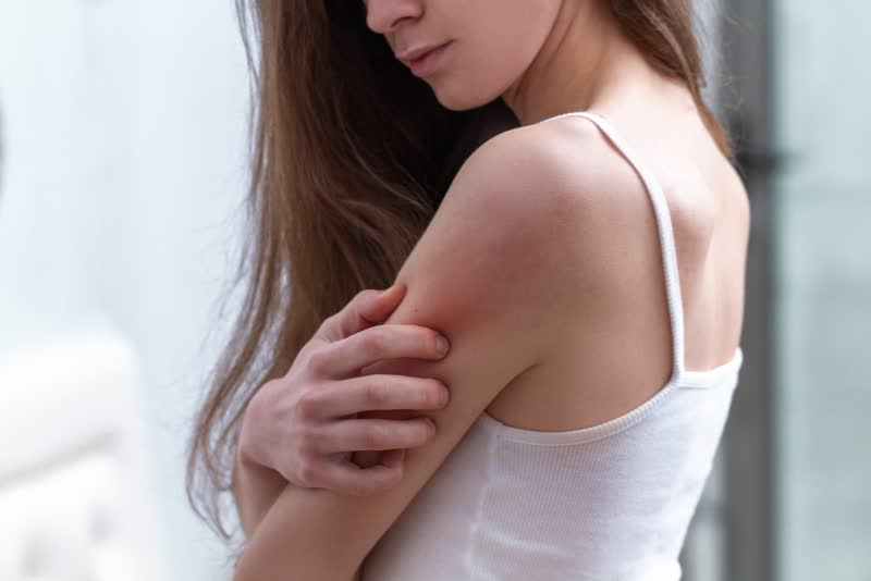 Foto di ragazza di profilo mentre si gratta il braccio sinistro arrossato a causa dell'orticaria