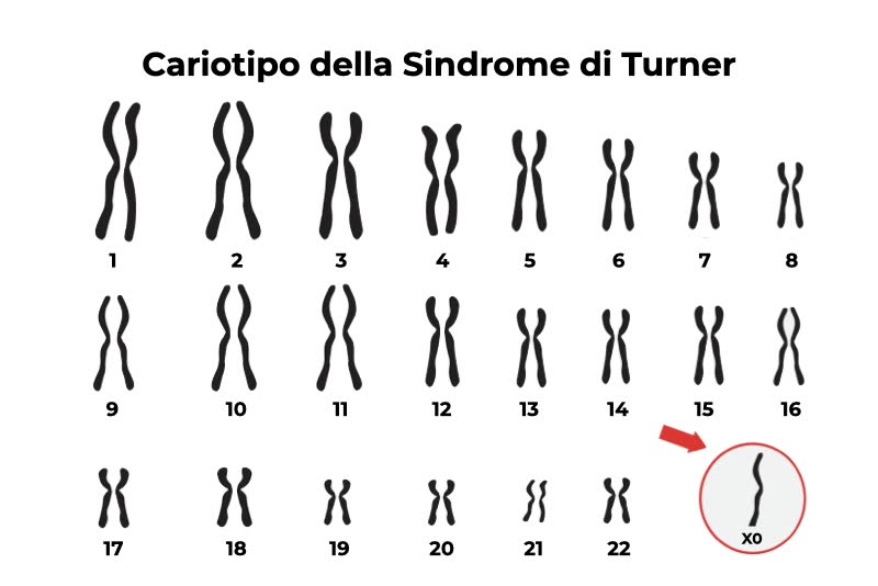 Illustrazione con i vari cariotipi della sindrome di turner