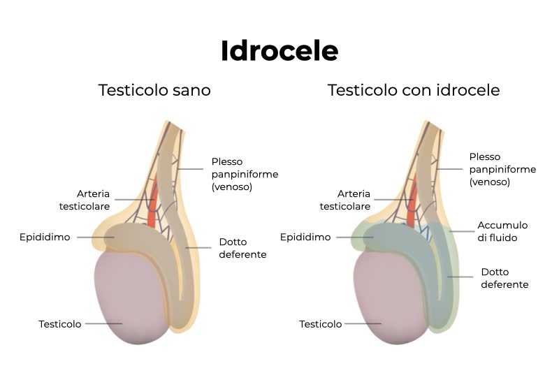 Illustrazione 3d di due testicoli, uno sano e uno affetto da Idrocele, con liquido presente all'interno dello scroto