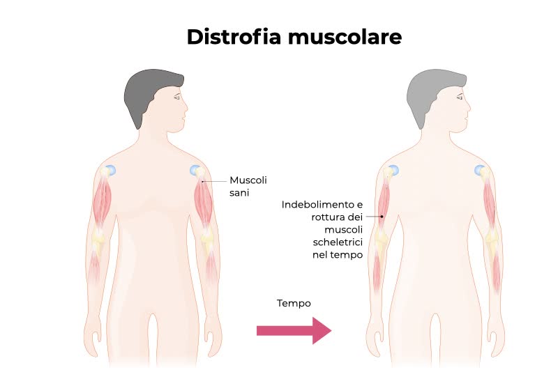 Illustrazione 3D di due corpi con muscoli sani e muscoli affetti da distrofia muscolare