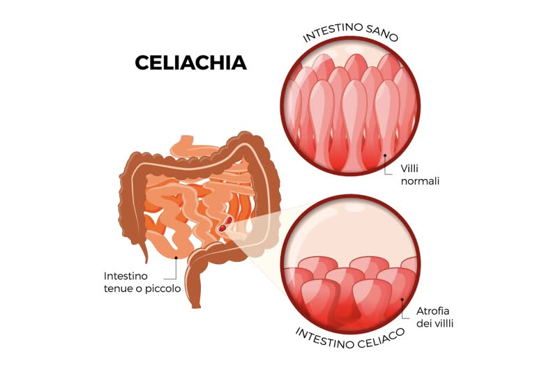 Illustrazione di un intestino con primo piano di villi intestinali normali e di villi in caso di morbo celiaco