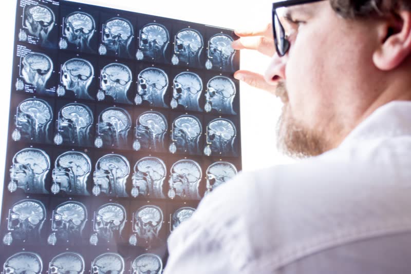 Foto di medico che valuta i risultati della risonanza magnetica del cervello nella foto di un soggetto in ospedale. Il neurologo, con gli occhiali, tiene la mano sul vetro illuminato (negatoscopio) della scansione MRI per esaminare la struttura del tessuto cerebrale ed escludere o confermare la presenza di sclerosi multipla (SM)