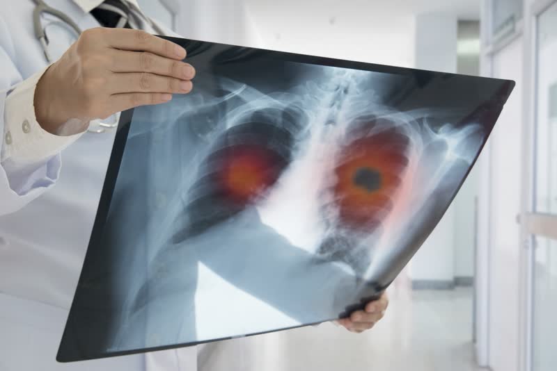 Foto di immagine radiografica che mostra polmoni con masse neoplastiche, sintomo della presenza di un tumore ai polmoni