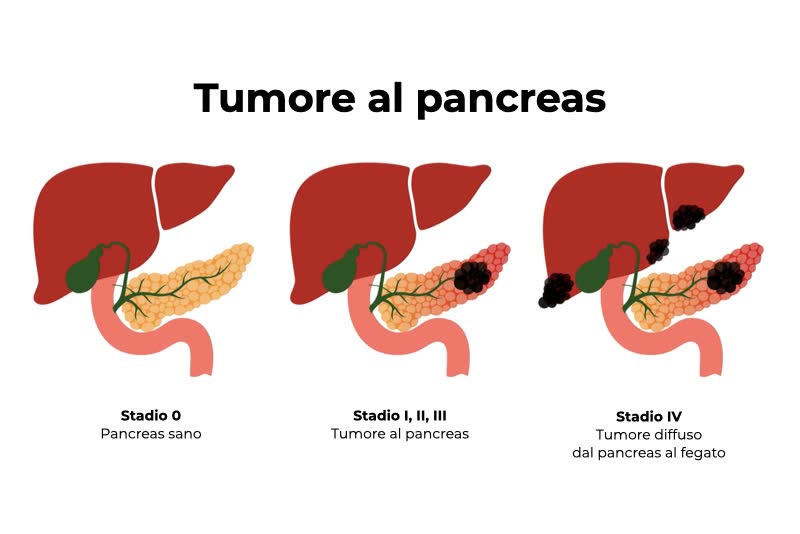 Illustrazione dei vari stadi del tumore sano, da sano a metastatico (tumore metastatico del fegato)