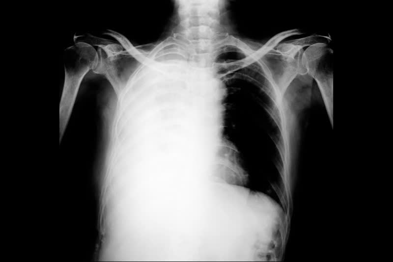 Immagine radiografica di un torace che presenta edema polmonare