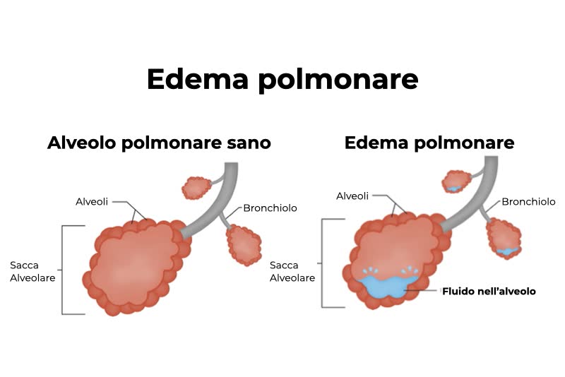 Illustrazione di alveolo polmonare sano e alveolo malato per colpa di edema polmonare che presenta fluido all'interno dell'alveolo
