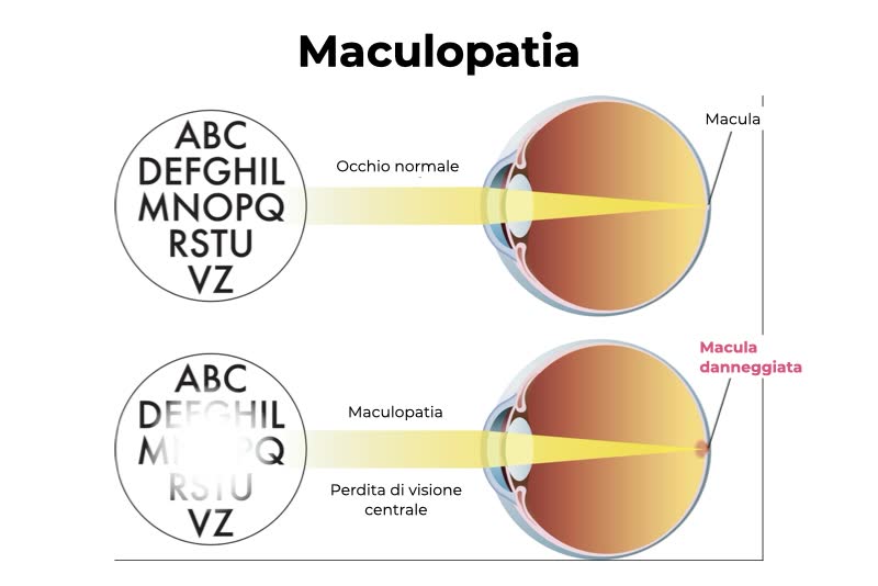 Illustrazione di occhio con macula danneggiata che causa maculopatia, con perdita di visione centrale