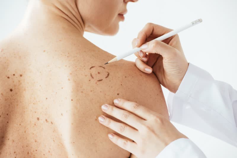 Foto di dermatologo che cerchia un melanoma sulla schiena di una paziente