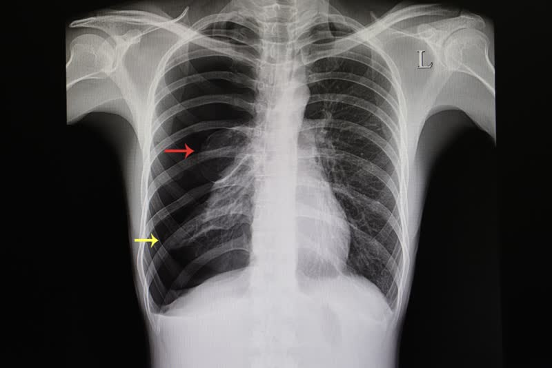 Immagine radiografica di polmone colpito da pneumotorace, con collasso totale del polmone destro