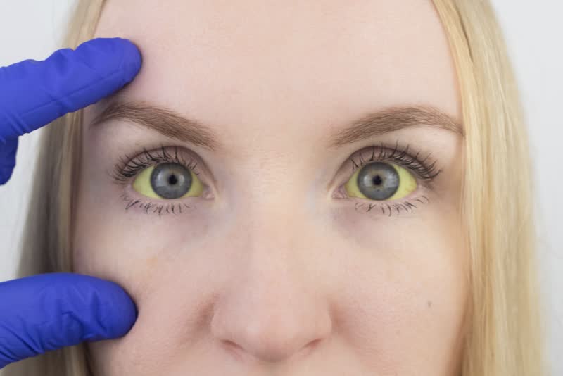 Foto di donna con occhi con ittero, una delle manifestazioni tipiche di problematiche al fegato come l'epatite c
