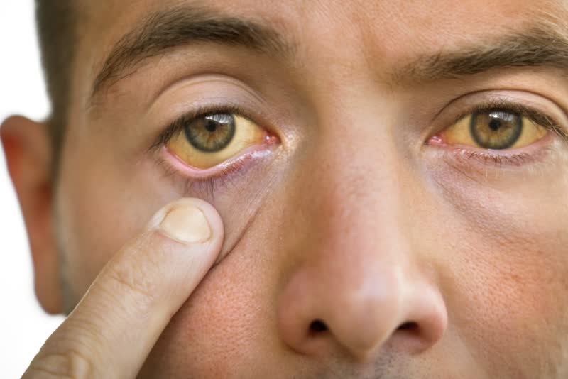 Foto di uomo con occhi gialli, segno di ittero, una delle manifestazioni di patologie al fegato come epatite A