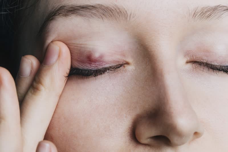Foto di donna con calazio sulla palpebra dell'occhio destro