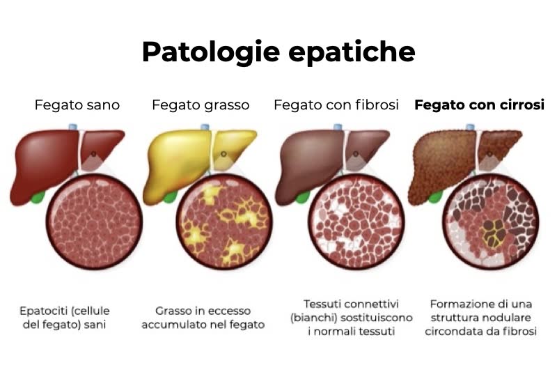 Illustrazione di varie patologie epatiche a confronto con fegato sano, tra cui fegato grasso, fibrosi e cirrosi epatica