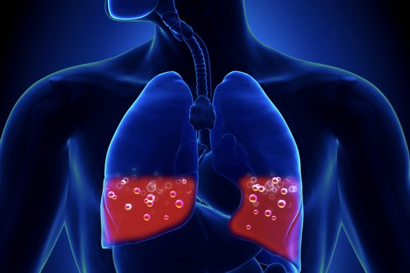 Illustrazione di un torace con polmoni con all'interno del liquido che causa un edema polmonare per rappresentare l'argomento per questo articolo
