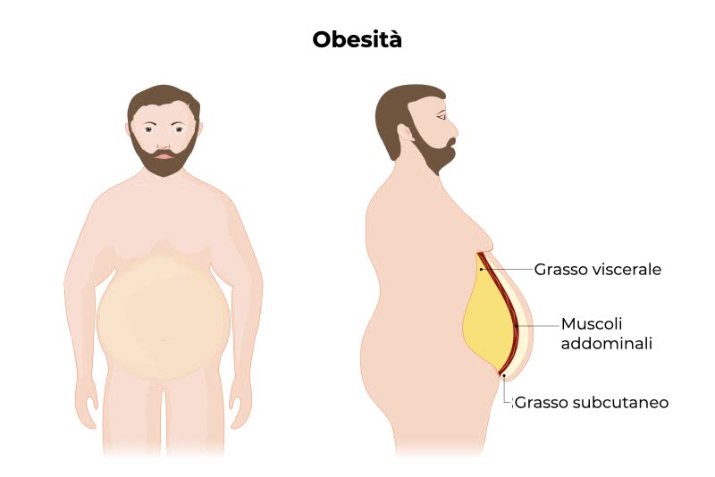 Illustrazione di uomo frontale e laterale affetto da obesità con spiegazione di cosa avviene a livello addominale in termini di grasso e parete muscolare