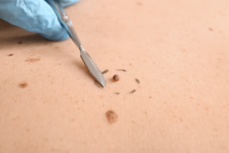 Immagine fotografica di un neo cerchiato durante un esame per verificare se si tratta di un semplice nevo o di un tumore della pelle.