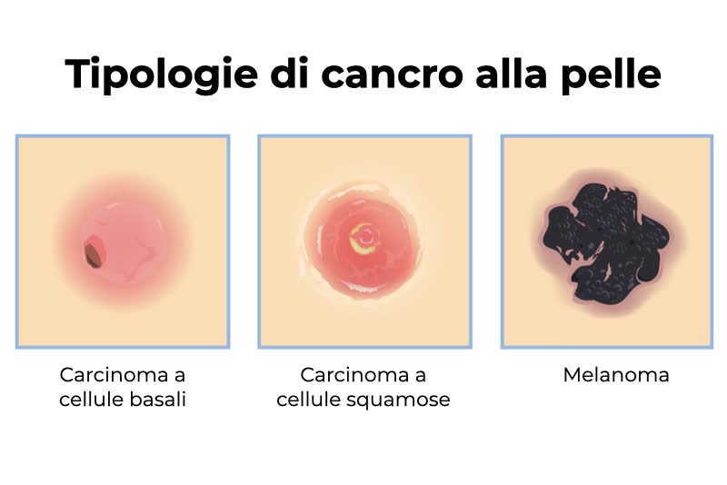 Illustrazione con le principali tre tipologie di tumore dalla pelle, dai carcinomi ai melanomi.