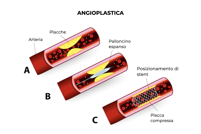 Illustrazione di come avviene il posizionamento di stent tramite angioplastica