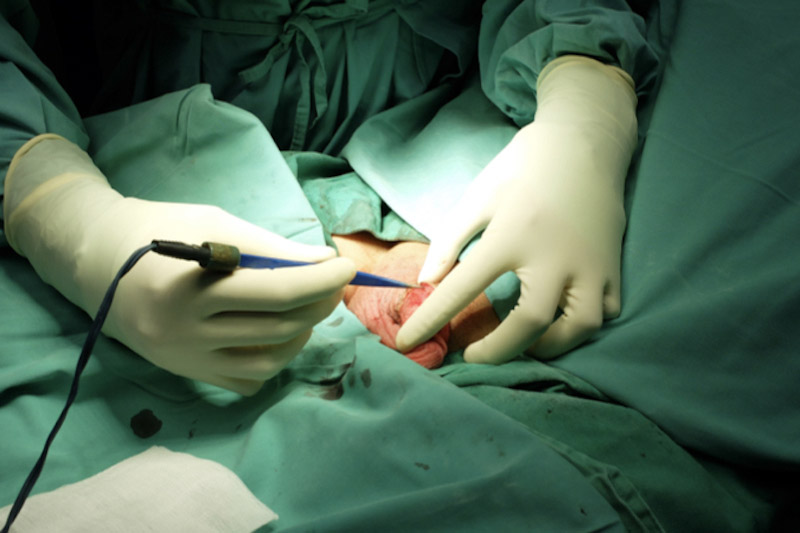 Primo piano di un intervento di circoncisione
