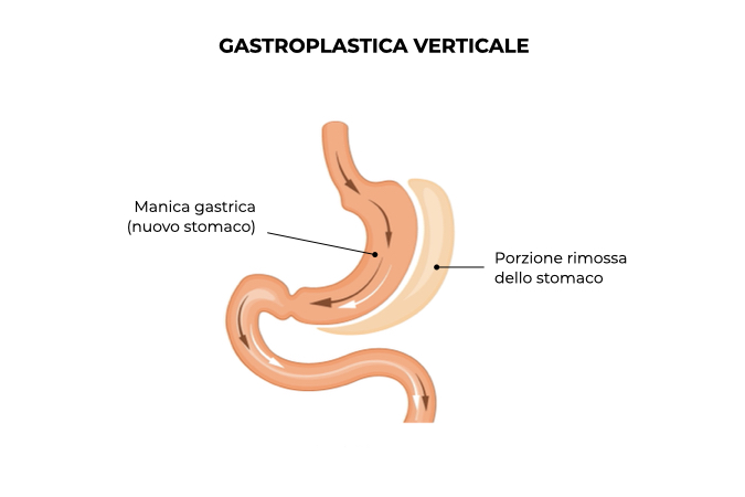 Illustrazione di uno stomaco con gastroplastica verticale