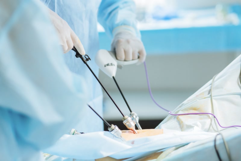 Immagine in primo piano di una equipe medica nel corso di un'operazione ginecologica di colpoisterectomia per la rimozione dell'utero tramite strumentazione laparoscopica
