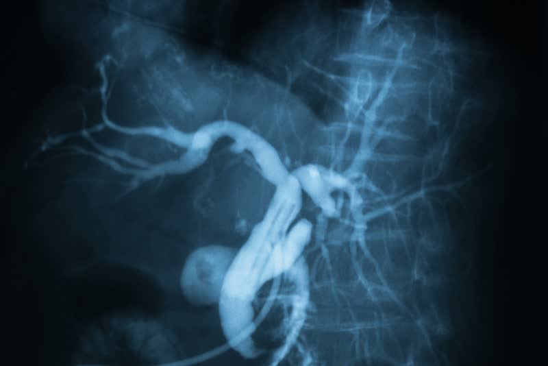 Immagine a raggi X di un'angiografia epatica, funzionale allo svolgimento della radioembolizzazione