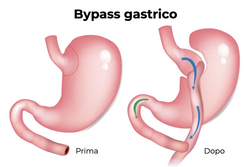 Illustrazione di un bypass gastrico: a sinistra uno stomaco normale, a destra ad intervento riuscito della tecnica RNY (Roux-en-y)