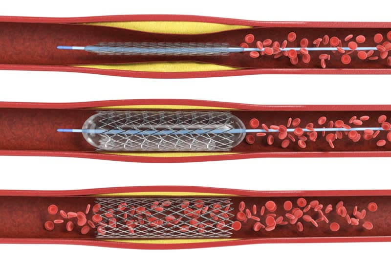 Illustrazione 3d di una procedura di angioplastica con palloncino con stent in vena. Si nota come con lo stenting il sangue torna a circolare nella vena precedentemente bloccata